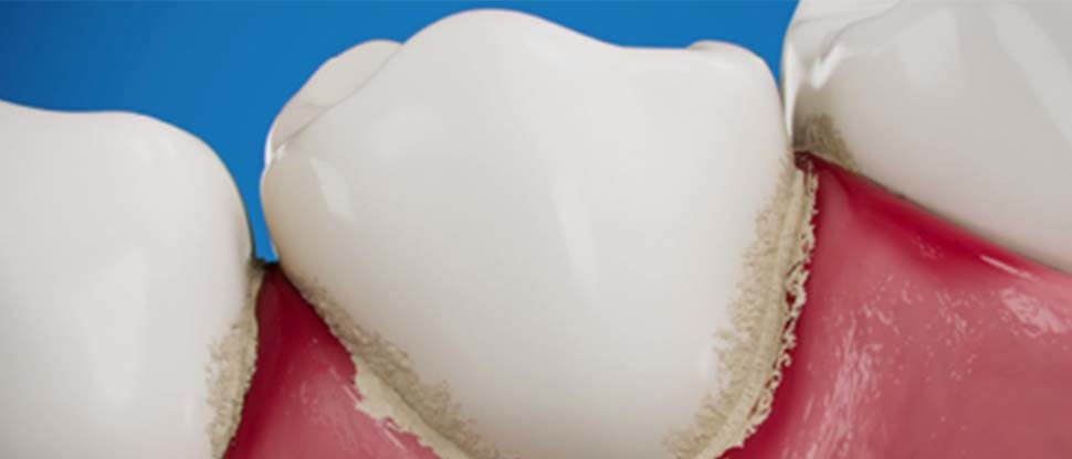 Mikro köpük teknolojisinin hassasiyet giderici diş macununda kullanımı