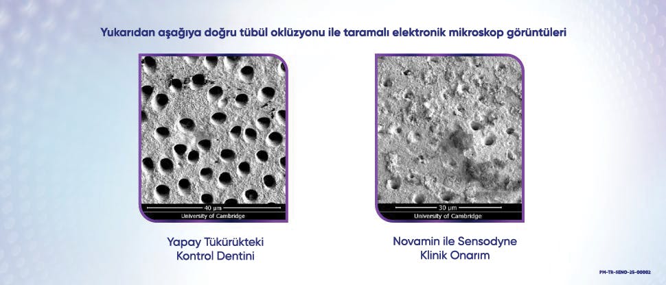 Diş macunu ile tedavi sonrası dentin tübüllerinin görüntüsü. 