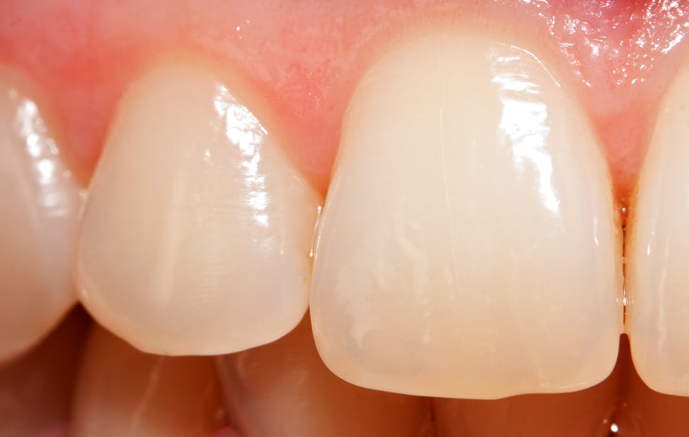 琺瑯質受磨損的牙齒
