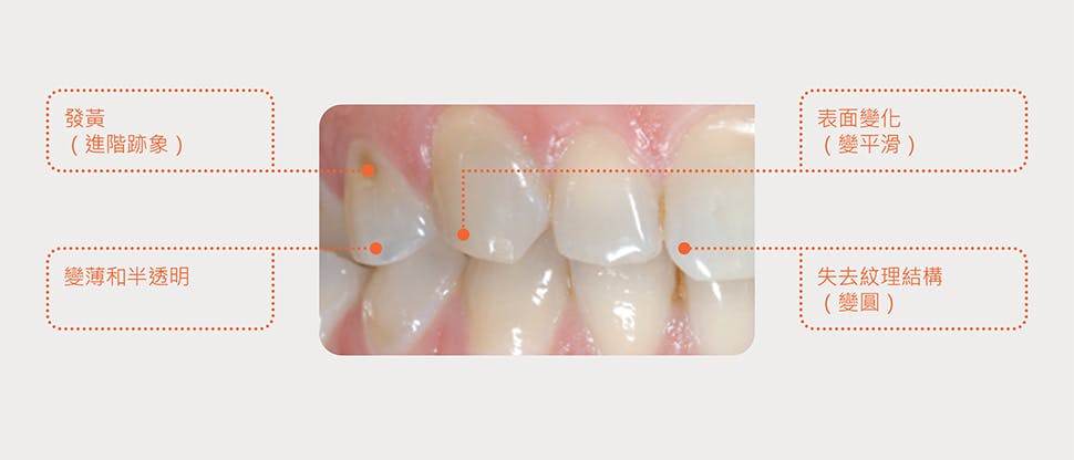 牙齒琺瑯質磨損