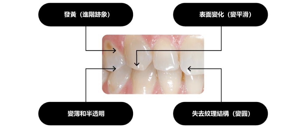 琺瑯質酸蝕的常見特徵