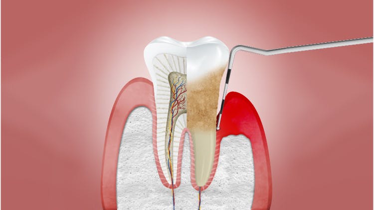 罹患慢性牙周病的牙齦剖面圖