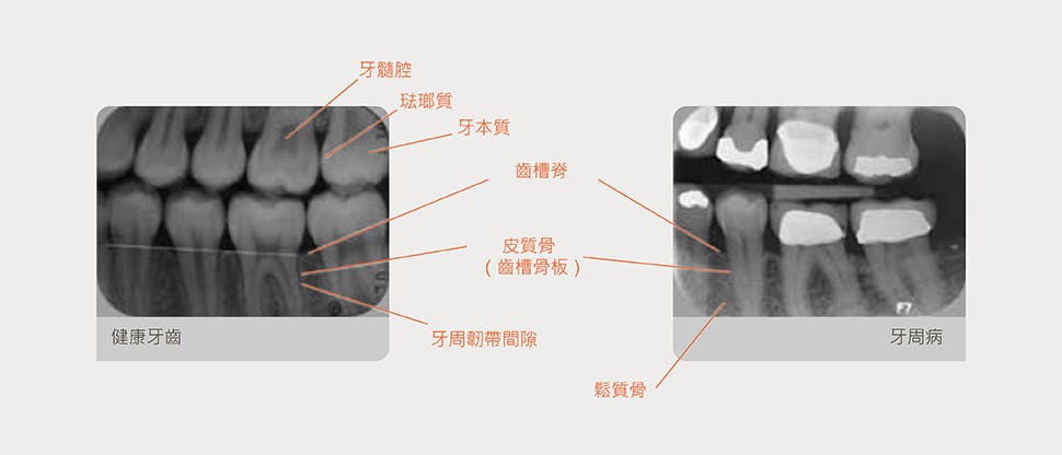 加上註解的射線照片