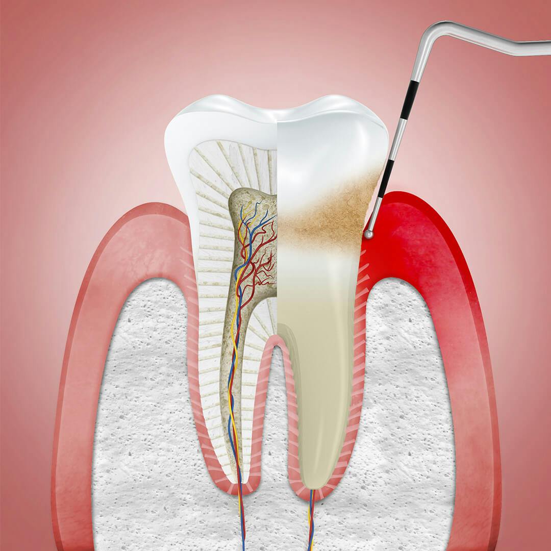 Ilustrace zobrazující dáseň zasaženou zánětem a ošetřovanou dentálním nástrojem