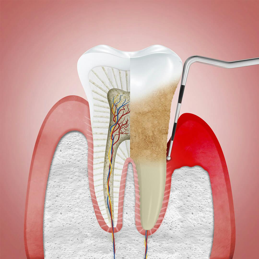 Ilustrace zobrazující dáseň trpící periodontitidou a ošetřovanou dentálním nástrojem