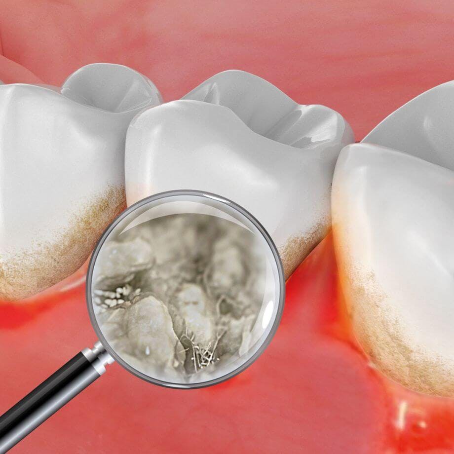 Ilustrace zobrazující bakterie, které se usazují mezi zubem a dásní