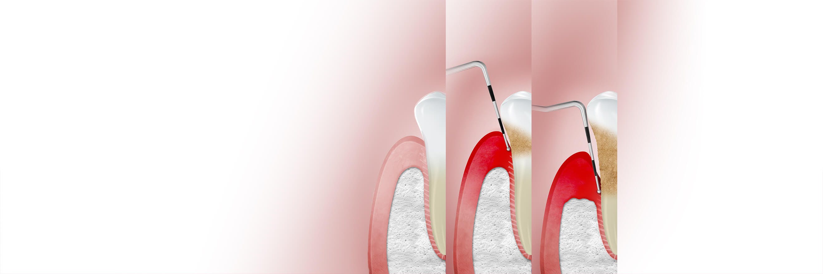 Ilustrace s nápisem "stádia" zobrazující různá stádia onemocnění dásní