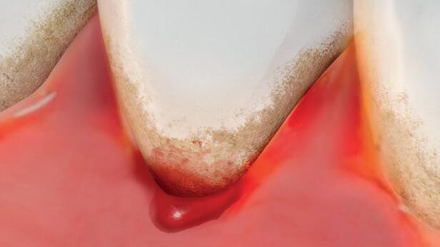 Ilustrace zobrazující krvácení dásní