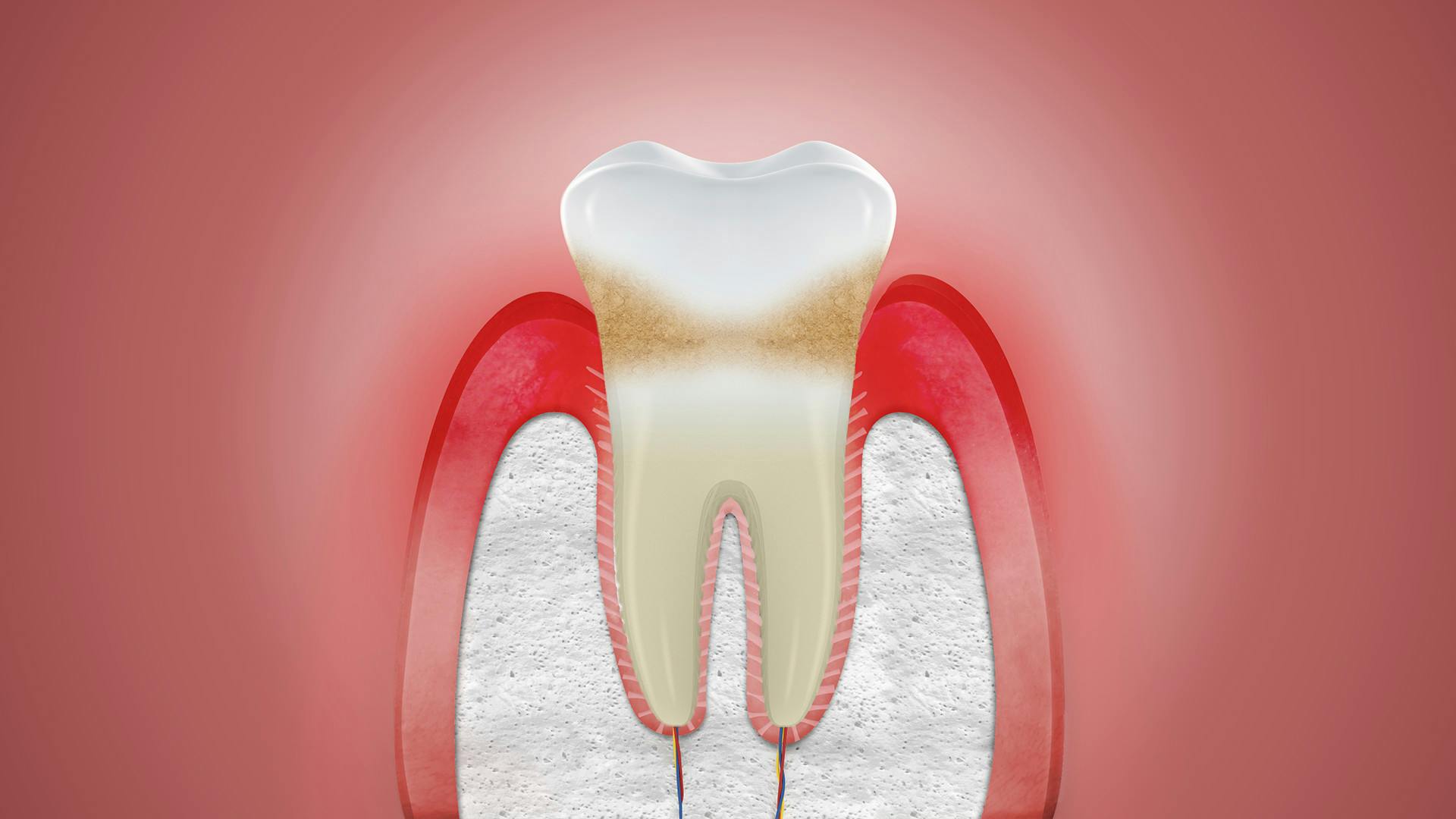 Ilustrace zobrazující oteklé dásně