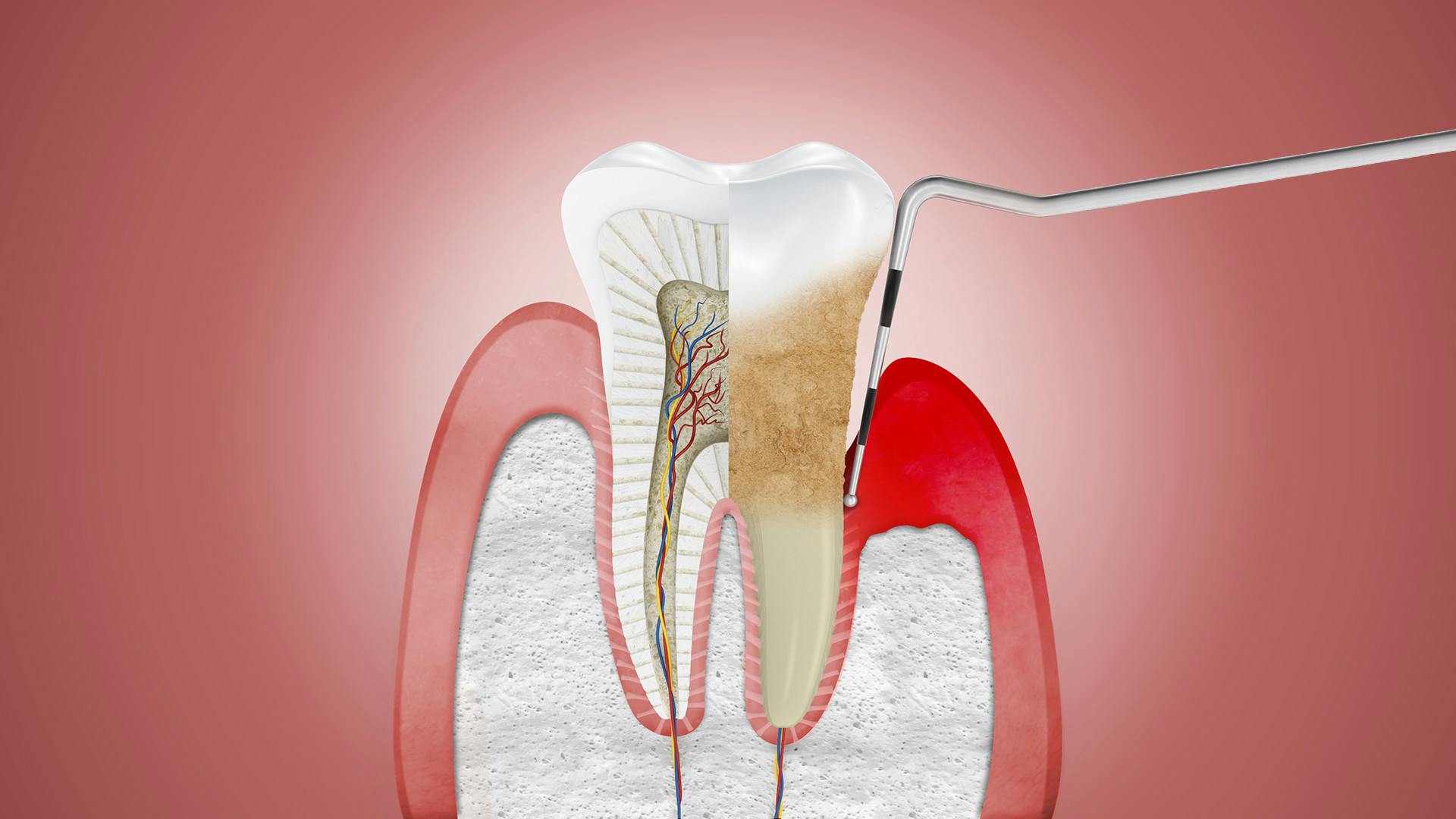 Ilustrace zobrazující dáseň trpící periodontitidou a ošetřovanou dentálním nástrojem