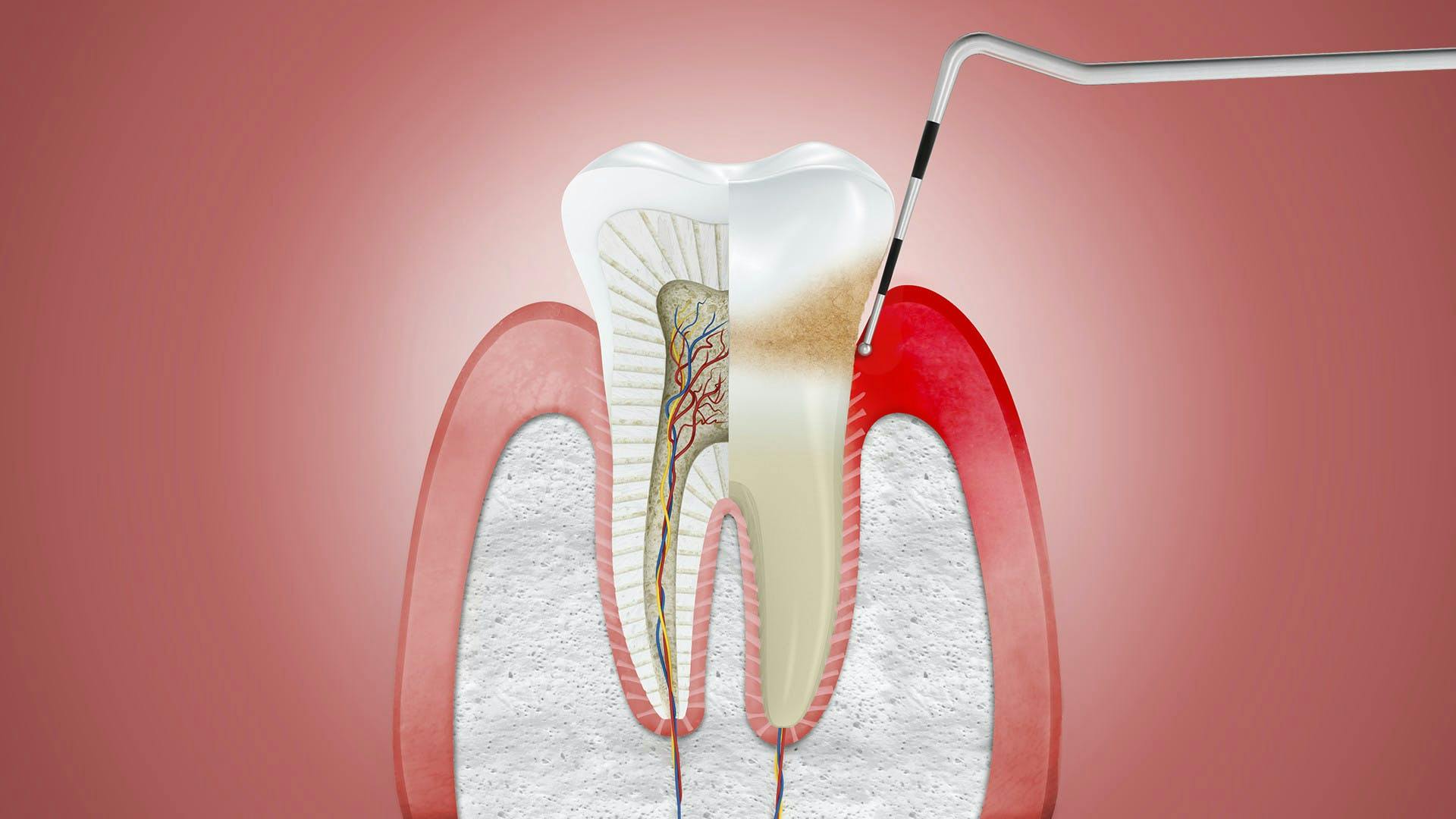 Illustration of gums affected by periodontitis, with dentist tool