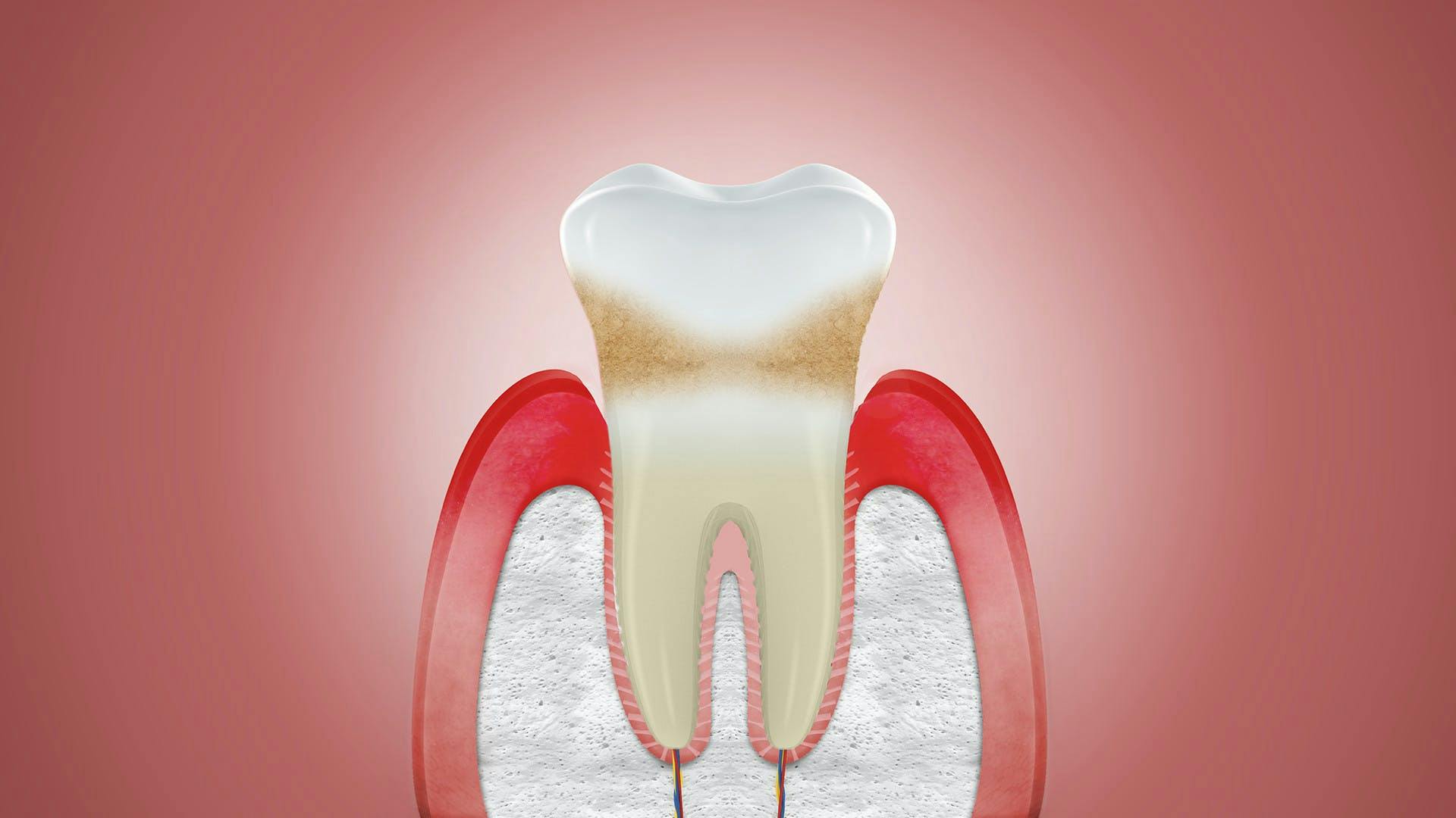 Illustration of swollen gums