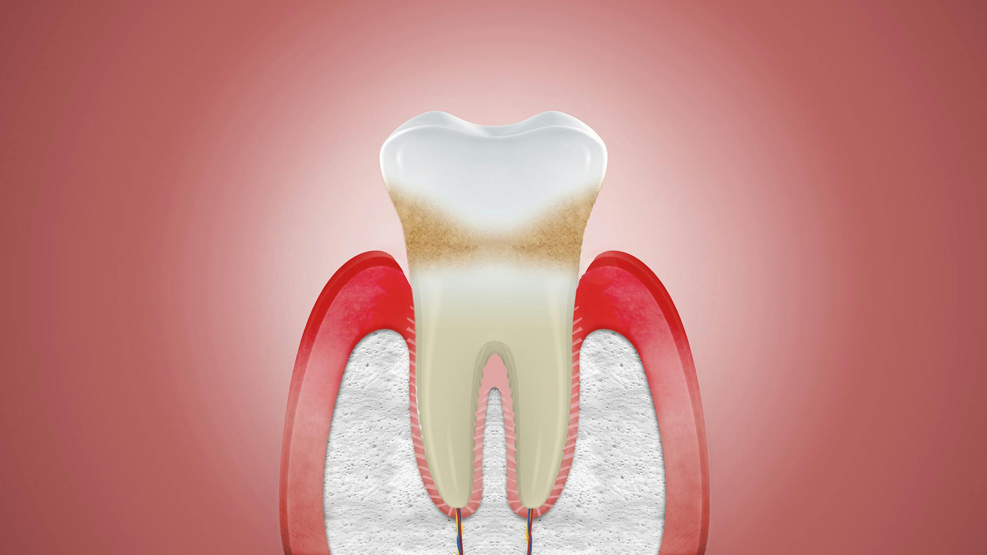 Darstellung von Zahnfleischschwund. Was tun bei Zahnfleischrückgang? Hier lesen.