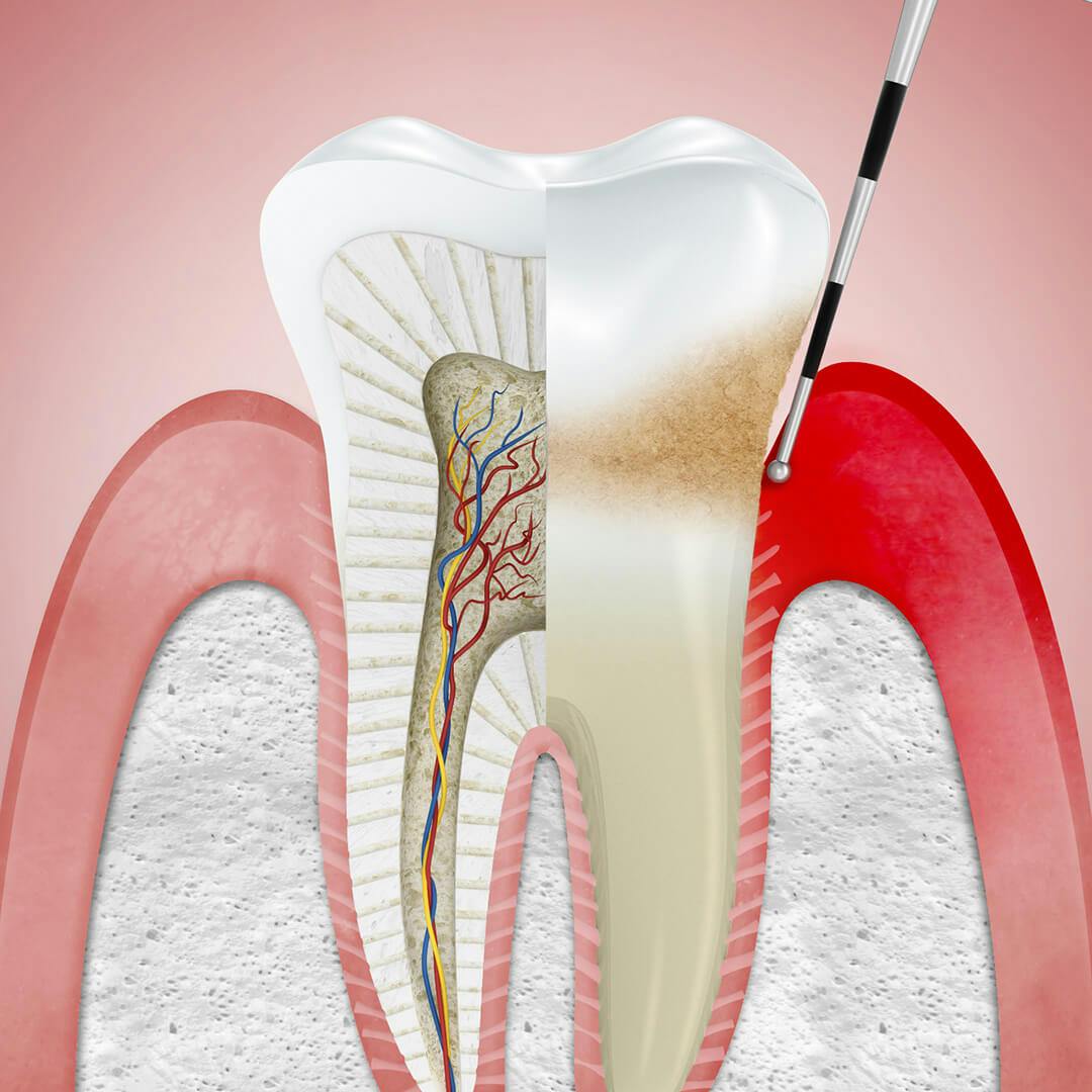 Illustration of gums affected by gingivitis, with dentist tool