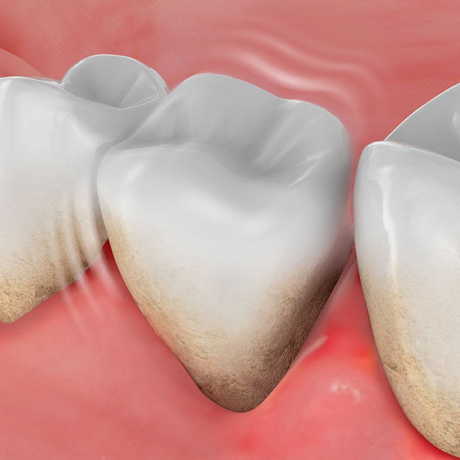 Immagine rappresentativa della perdita del dente