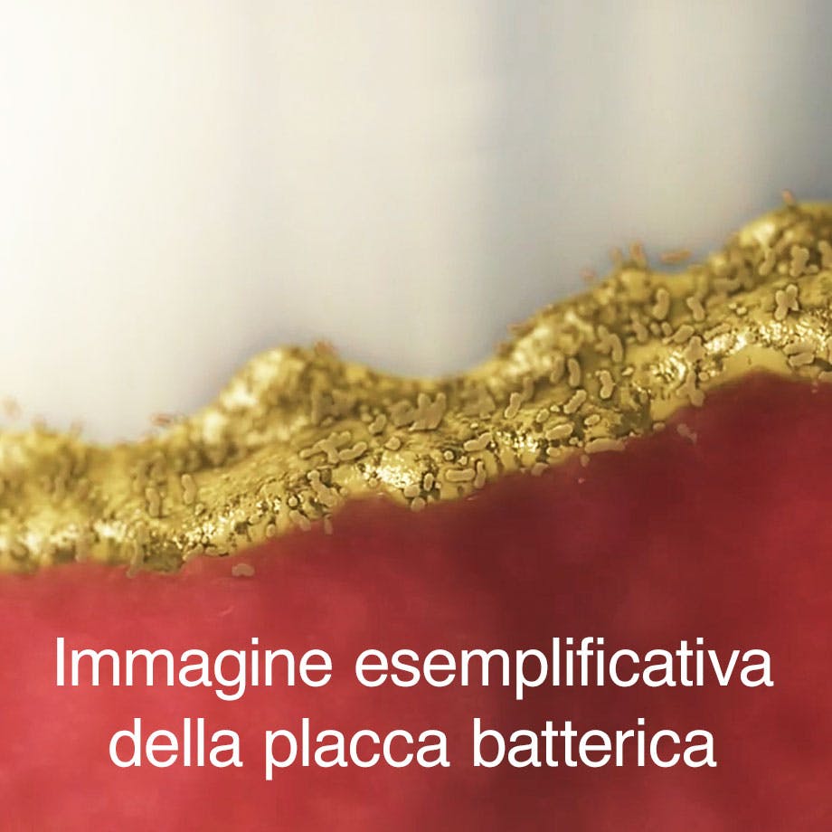 Immagine rappresentativa di accumulo di batteri sul bordo gengivale