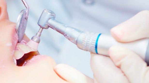 歯医者での歯のクリーニング