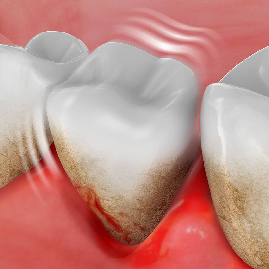 Klibantis dantis po negydomo dantenų uždegimo
