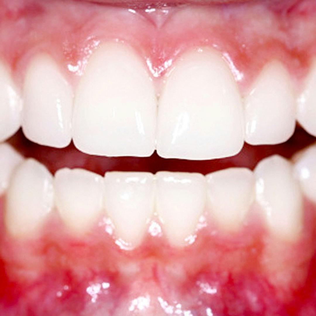 What are healthy gums?