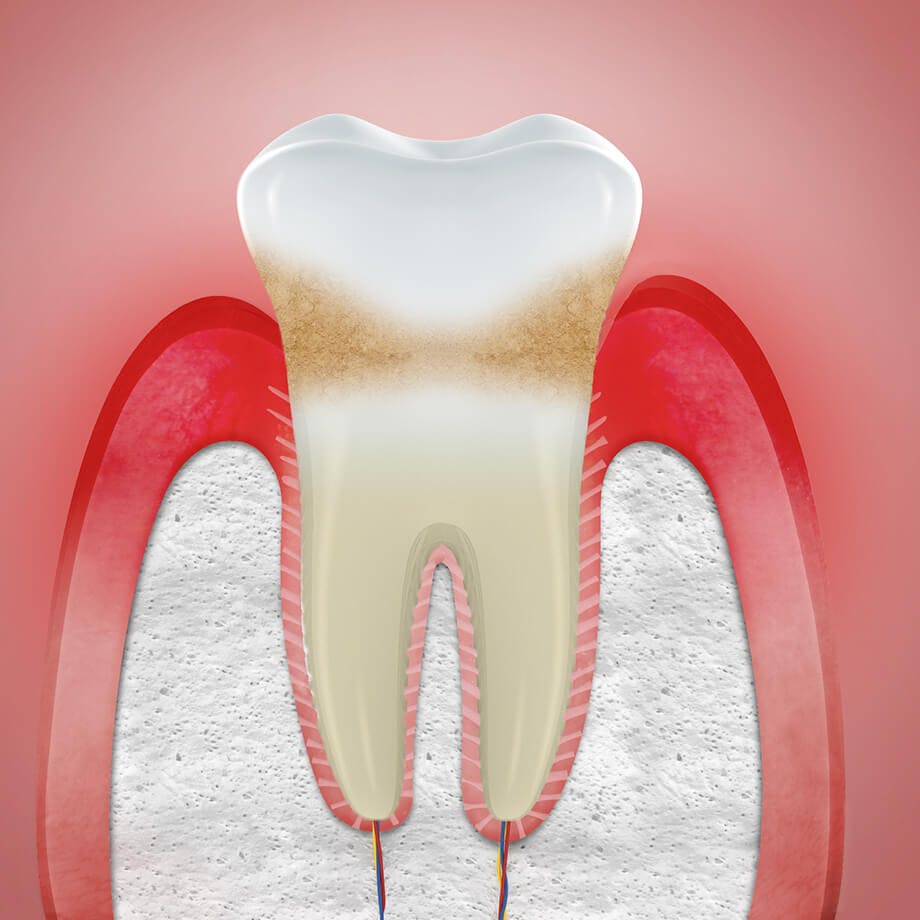 Symptômes de la gingivite : gencives rouges, irritées et gonflées