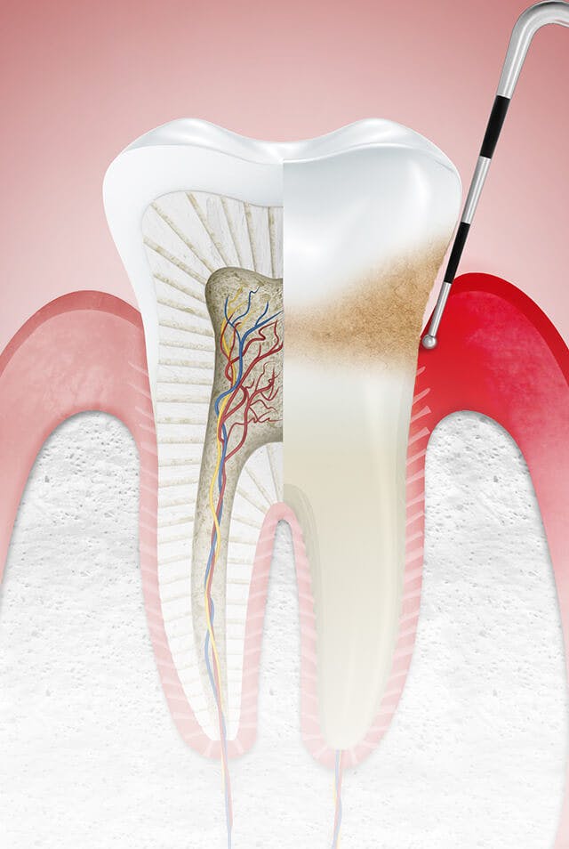 Illustration av tandkött påverkat av gingivit (tandköttsinflammation) med texten "Stadier"