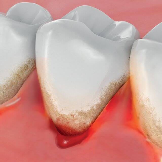 A tooth with a bleeding gum 