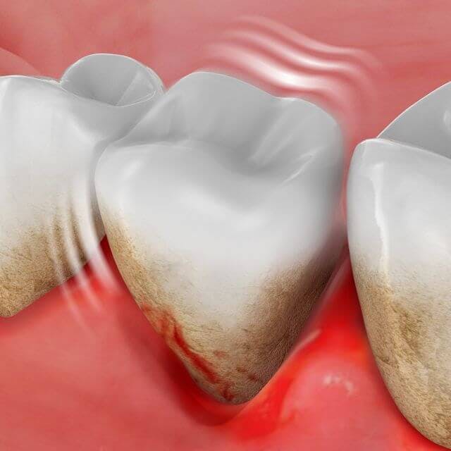 Tooth showing blood around the gum.