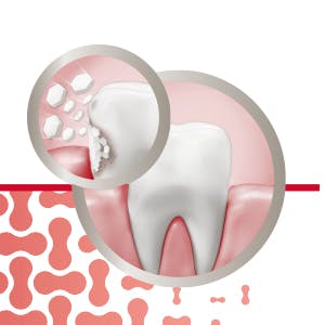 Crée une couche protectrice contre la sensibilité dentaire