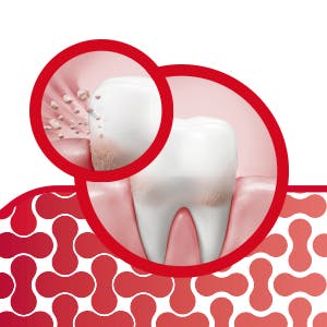 Cible en profondeur les bactéries de la plaque dentaire entre les dents
