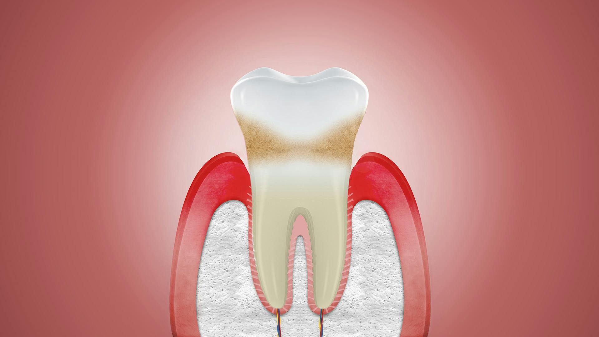 Illustration of receding gums