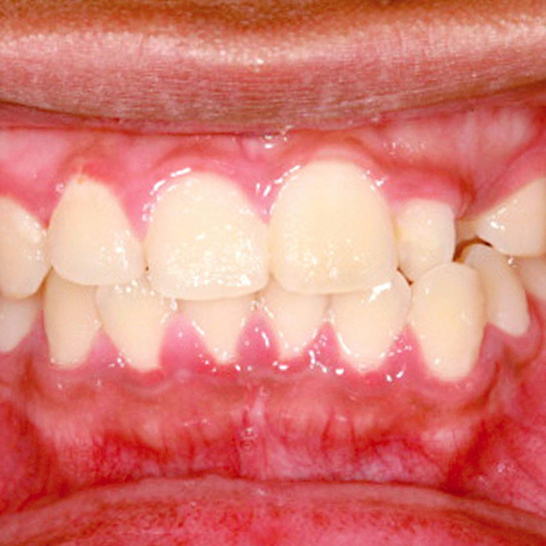Illustration of gums affected by gingivitis, with dentist tool