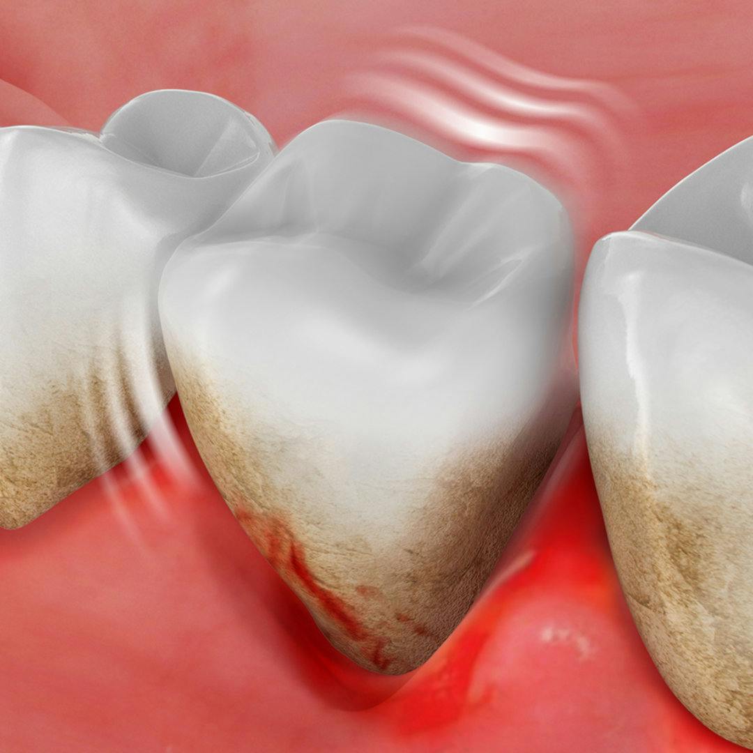 What is periodontitis and how can it lead to tooth loss?