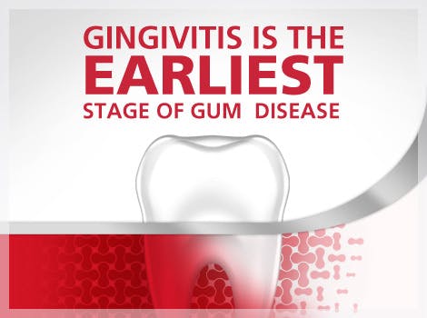 Imagen de diente y gingivitis