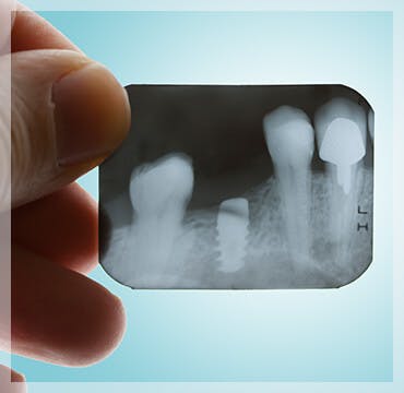 Radiografía dental