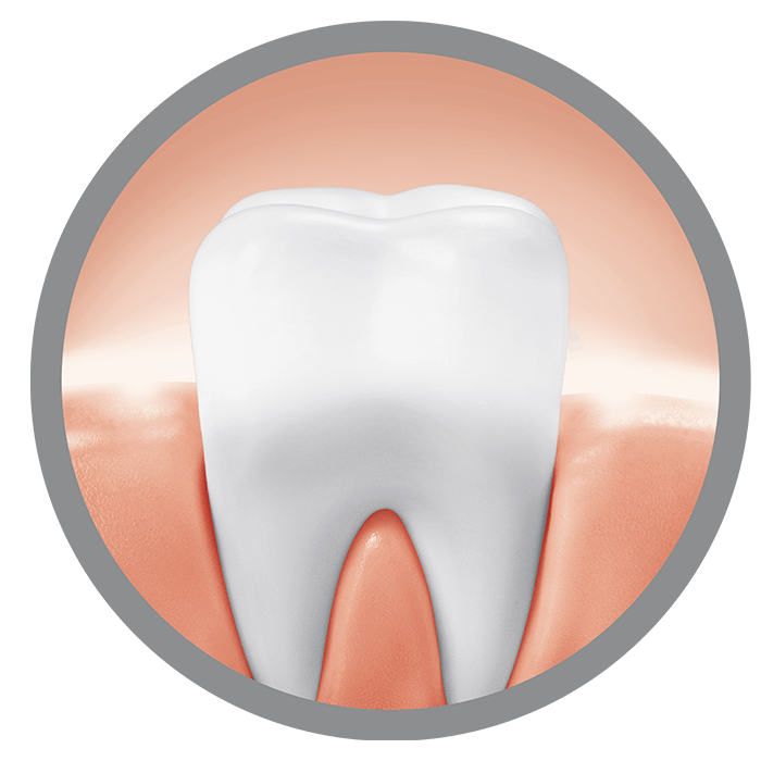 Bild erklärt wie eine Infografik anhand von drei Zähnen wie gesünderes Zahnfleisch entsteht 