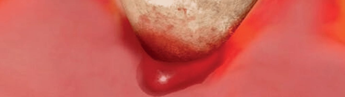 Abbildung Zahnfleischbluten