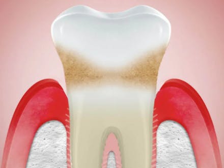 Abbildung Zahnfleischrückgang