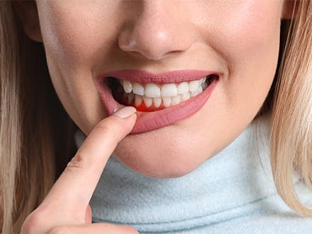 How to Treat Gingivitis at Home