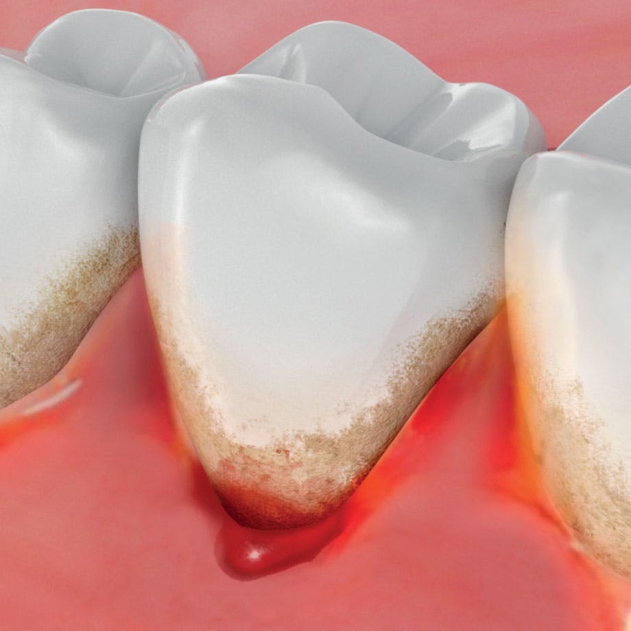 5 Reasons Bleeding Gums Mean It's Time For a visit To the Dentist