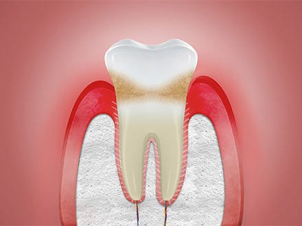 protection of teeth and gums