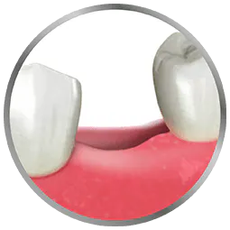 tooth loss