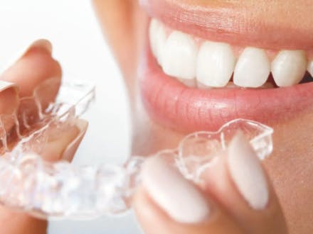 Woman about to insert a clear plastic removable retainer