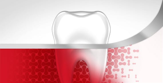 Bleeding Gums Tooth Gum Disease Stage 1 parodontax