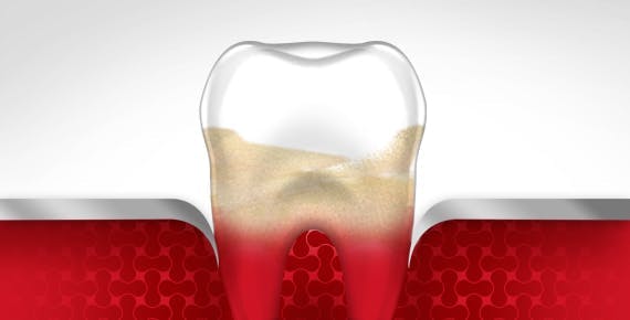 Bleeding Gums Tooth Gum Disease Stage 3 parodontax