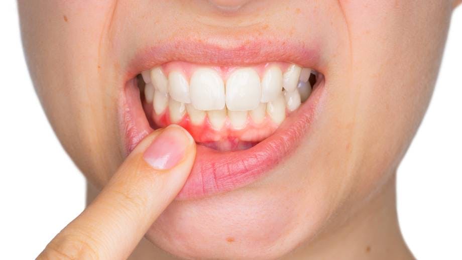 Close-up picture of woman showing gums