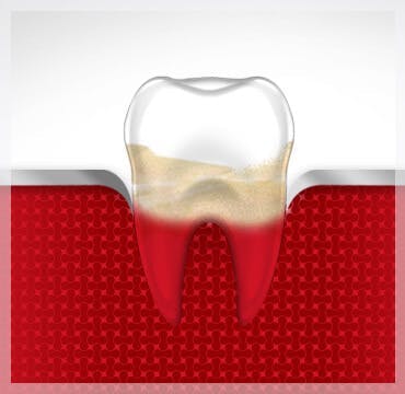 How To Treat Gingivitis