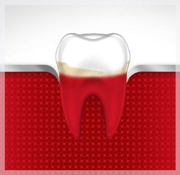 How To Treat Gingivitis