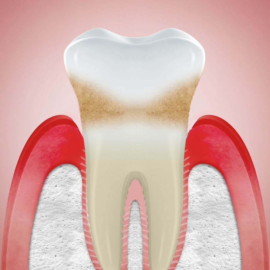 Animerad bild på ett tvärsnitt av en tand som visar tillbakadraget tandkött