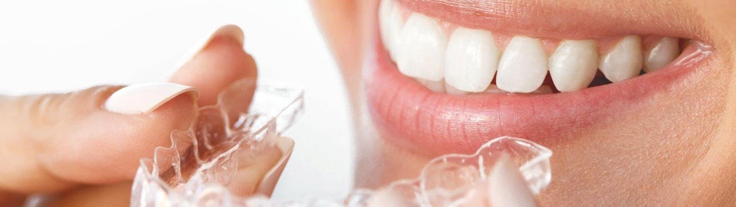 Kvinna sätter in genomskinlig tandskena i munnen