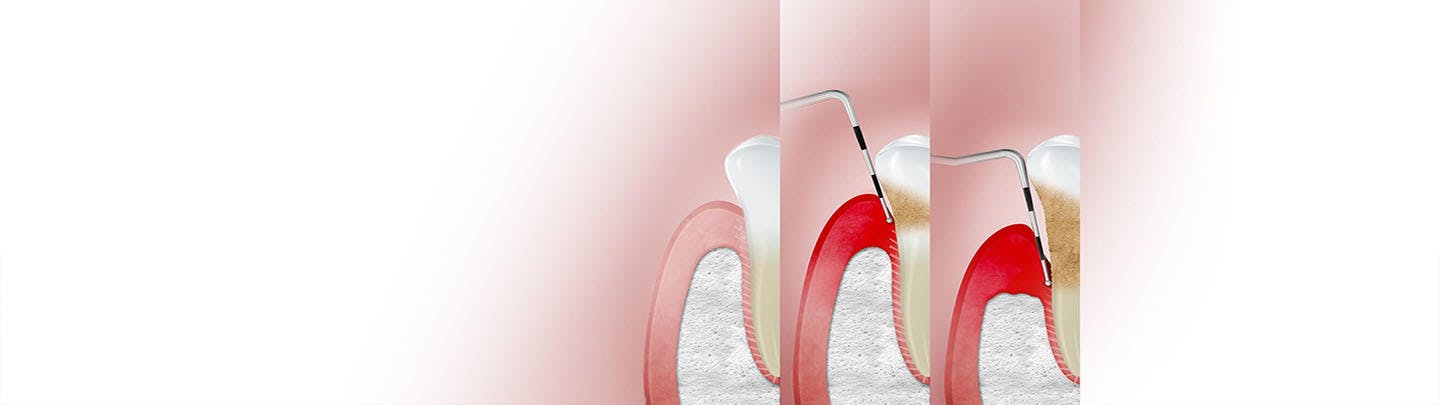 Abbildung wie Gingivitis das Zahnfleisch betrifft mit dem Label "Stufen"